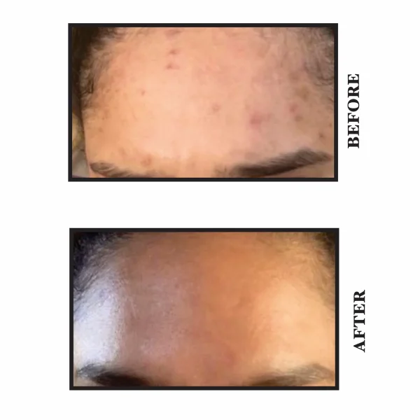 YearnSkin Salicylic Cleansing Gel before and after